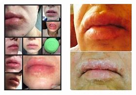 chapped lips - images