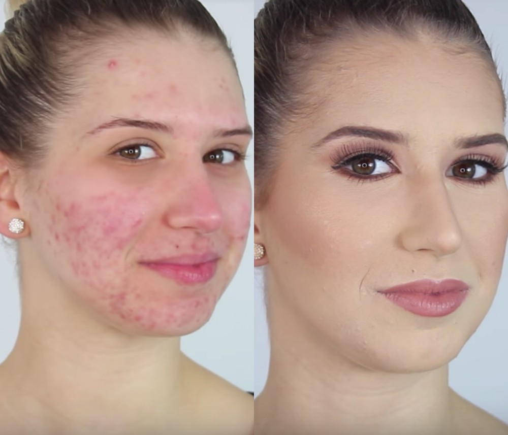 Best Acne Treatment System Get Clearer Beautiful Skin Today Buy Now 