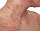 Skin Disorders - small picture of Eczema Rash.
