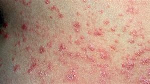 Skin Disorders - pic of Psoriasis Rash.
