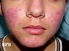 Skin Disorders - pic of Rosacea Rash.