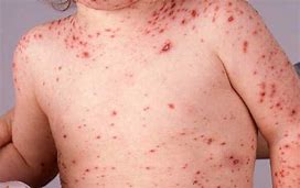 Chickenpox - Picture of the chickenpox rash. 