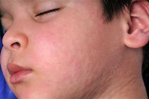 Chickenpox - Pic of the Mumps on a child's face.