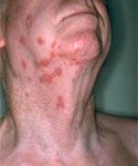 Shingles treatment - picture of shingles on the neck. 