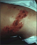 Shingles treatment - picture of shingles on the waist. 