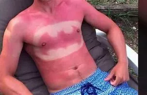 Picture of a bad sunburn. Sunburn - Picture of bad sunburn.