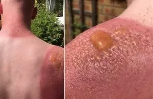 Pictures of blistering Sunburn. Sunburn - Pictures of blistering Sunburn.