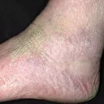 Dry Skin - Picture of dry skin around the ankle. 