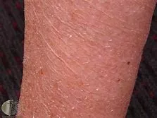 dry skin - picture of severely dry skin.
