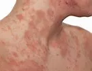Skin disorders, Top-Rated Anti-Aging Skincare Products Are Available Today! Skin disorders