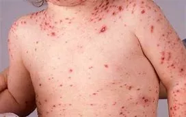 chickenpox, Top-Rated Anti-Aging Skincare Products Are Available Today! chickenpox