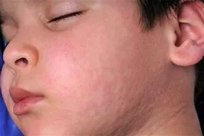 chickenpox, Top-Rated Anti-Aging Skincare Products Are Available Today! chickenpox