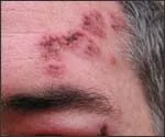 shingles treatment, Top-Rated Anti-Aging Skincare Products Are Available Today! shingles treatment